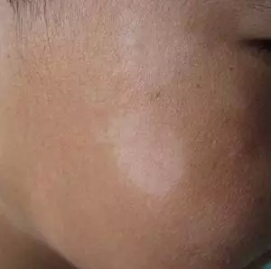每年春季,桃花盛开的时候,在一些小孩子和青年的脸上,往往会有一