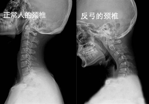 颈椎病查出“颈椎反弓”怎么办?