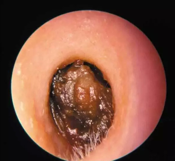 耳背近十年,只因耳屎在作怪