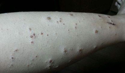 莫让疥疮成为健康的拦路虎