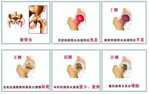 激素性股骨头坏死最佳_治疗时间是什么时候？