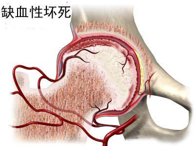 缺血性股骨头坏死什么情况下需要置换？