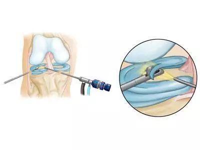 什么情况下需要做膝关节镜手术