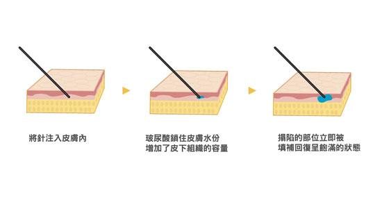 玻尿酸的作用有哪些？