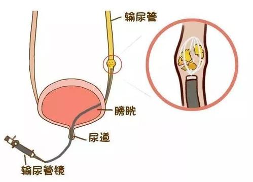 科普|肾结石微创手术过程