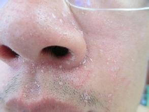 脂溢性皮炎除根的偏方(治疗脂溢性皮炎有什么好的偏方)