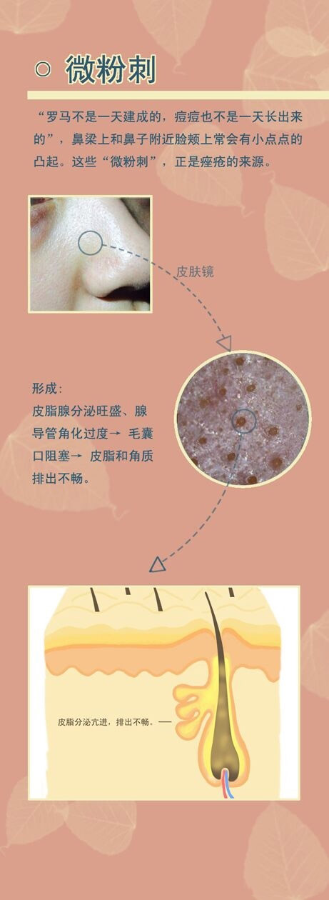 各种粉刺的图片,粉刺图片大全,身上长粉刺图片_大山谷图库
