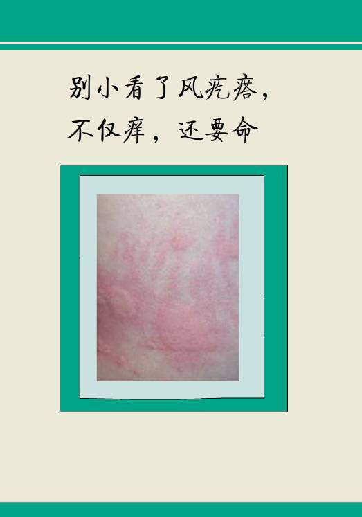 风团疙瘩图片,身上起风团图片,风团疹图片_大山谷图库