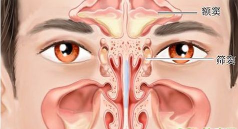 鼻窦炎的原因是什么？
