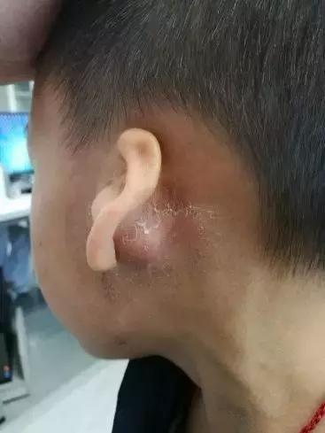 5岁男孩感冒发烧后,耳后竟鼓起红肿小包!